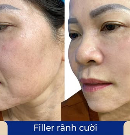 Messo đẩy rãnh cười