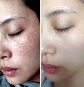 Messo nám phục hồi