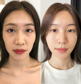 Messo xóa nhăn mắt
